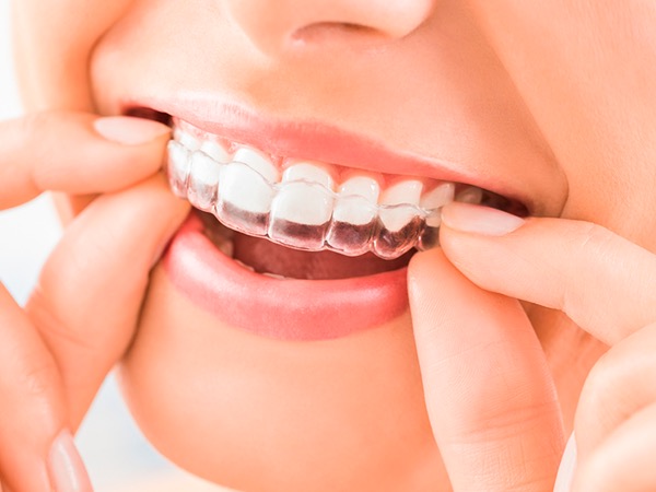 Ortodontija - nevidni alignerji Ljubljana